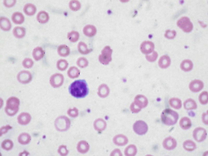 Microscopic view of iron deficiency anemia