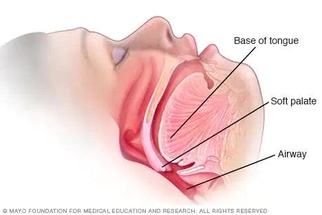 Understanding Snoring and Its Causes