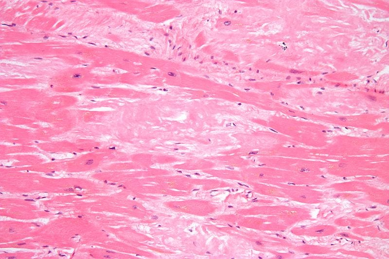 Biopsy showing amyloidosis in heart tissue