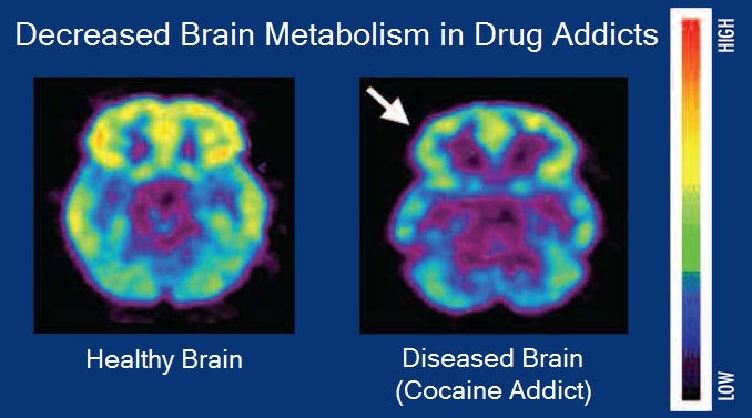 Image highlighting addiction's impact on the brain